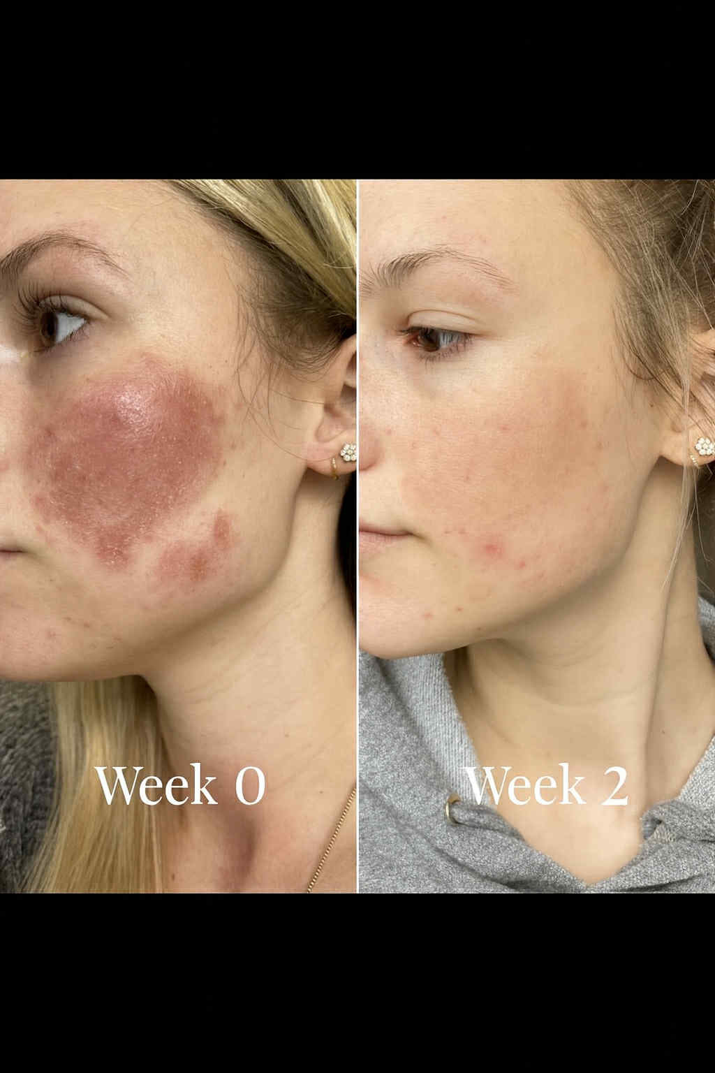 LumiAura™ LED light therapy results for acne scars after 2 weeks – before and after improvement, reduces redness and scarring – trusted skincare device in Texas, Louisiana, Arkansas, USA with fast shipping.