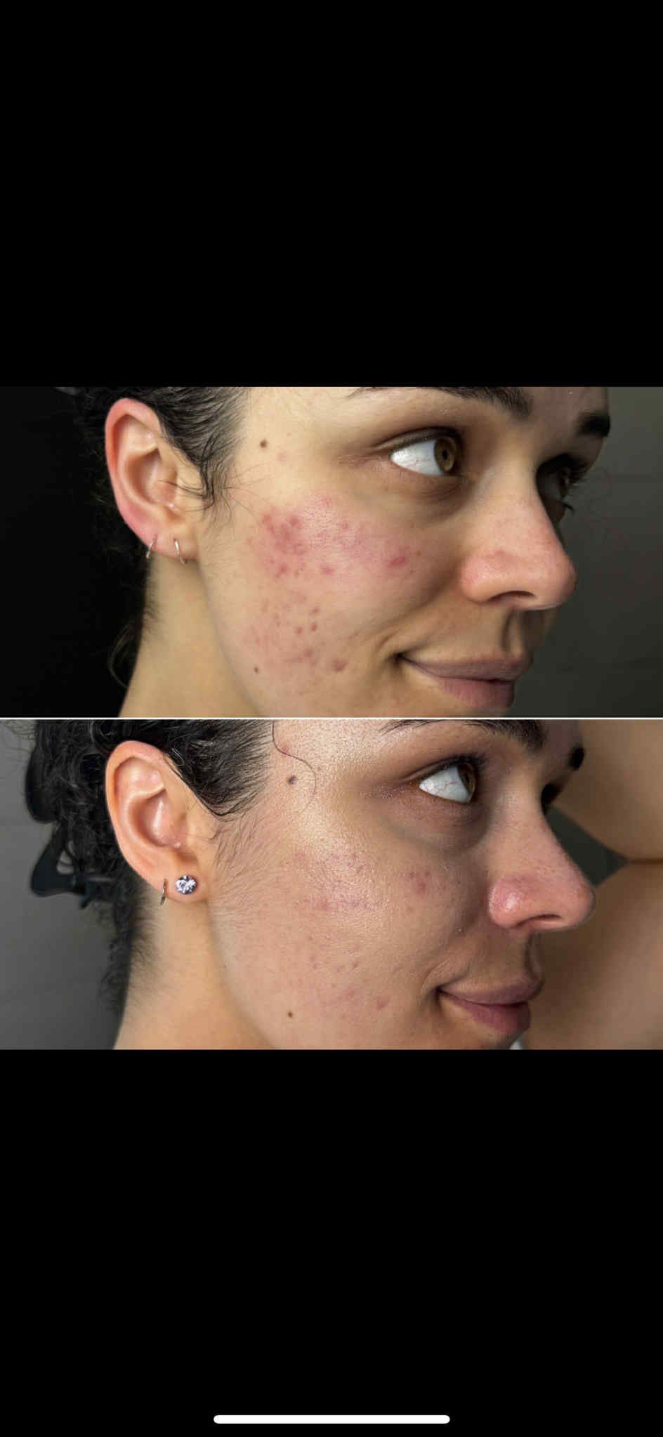 Before and after results of LumiAura™ LED face mask showing visible acne reduction, smoother skin texture, and clearer complexion after home LED therapy – fast USA shipping.